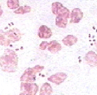 Neisseria Gonorrhoeae